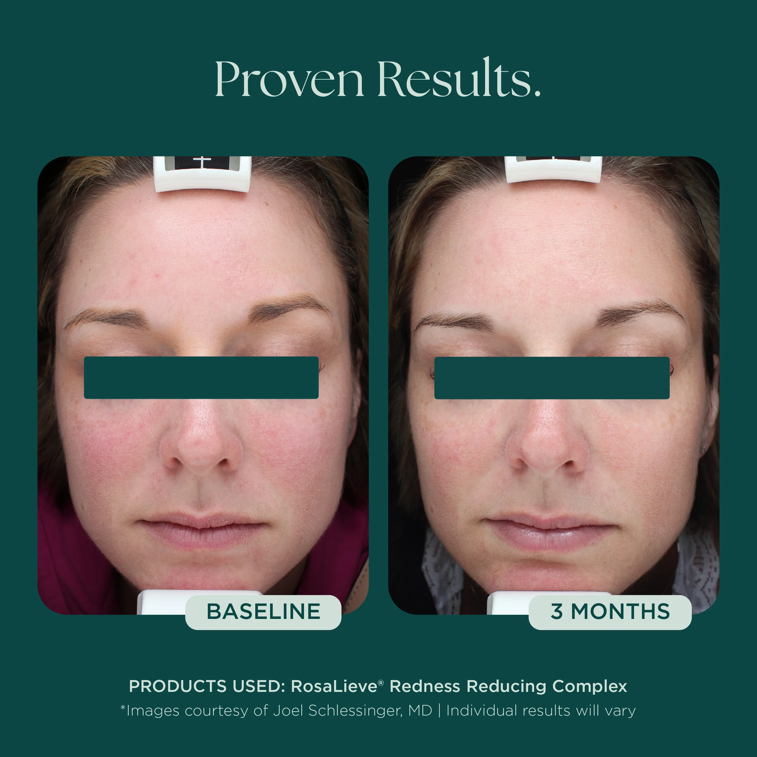 RosaLieve® Redness Reducing Complex - Image 9